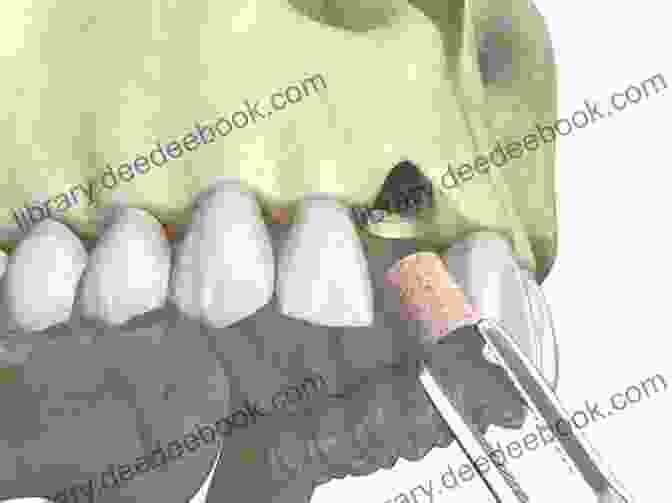 Diagram Of Crestal Sinus Grafting Procedure Showing The Placement Of Bone Grafting Material Onto The Crest Of The Jawbone. Sinus Grafting Techniques: A Step By Step Guide