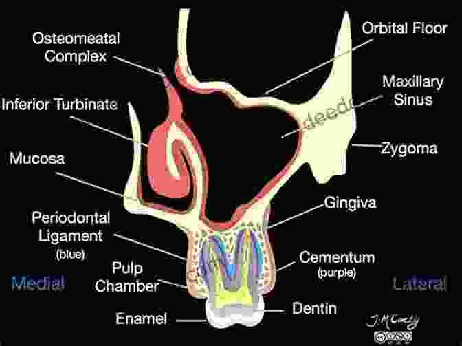 Diagram Of Sinus Anatomy Showing The Maxillary Sinus And Its Relationship To The Teeth And Jawbone. Sinus Grafting Techniques: A Step By Step Guide